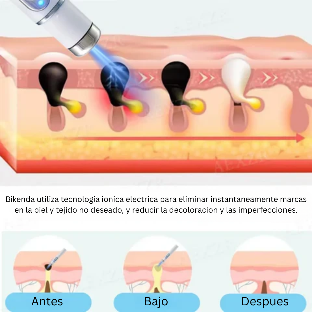 Lápiz Láser : Ayuda a mejorar la apariencia de verrugas y marcas en casa