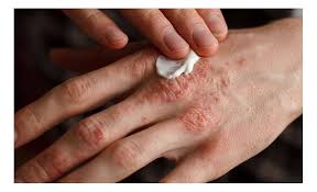 "Alivio natural y visible para tu piel con psoriasis"